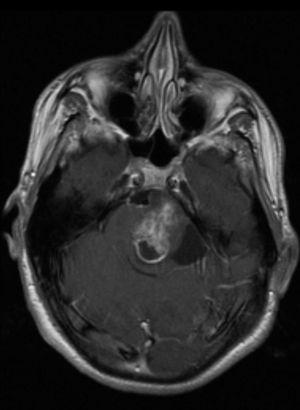 Resonancia magnética cerebral en secuencia T1 con contraste y plano axial, donde se evidencia una tumoración heterogénea, expansiva a nivel de protuberancia que capta contraste a nivel periférico. Los hallazgos corresponden a un tumor pilocítico de troncoencéfalo en un paciente con neurofibromatosis tipo 1.