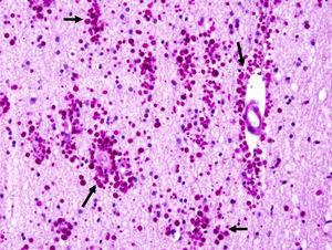 Acumulación marcada de cuerpos amiláceos (flechas) en la neocorteza (parénquima de la sustancia blanca y alrededor de vasos sanguíneos, grado 3) en un paciente con epilepsia del lóbulo temporal farmacorresistente. PAS×200.