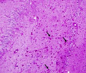 Numerosos cuerpos amiláceos (flechas) en el hipocampo (área CA4 y capa de células granulosas, grado 3) de un paciente con epilepsia del lóbulo temporal farmacorresistente. PAS×400.