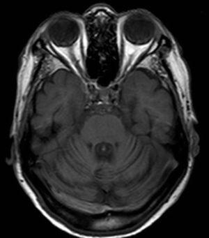 Caso 3. RM cerebral, secuencia T1 axial en la que se observa la atrofia del vermis y de los hemisferios cerebelosos.