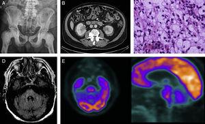 A) Rx simple de pelvis: osteosclerosis diáfiso-epifisario de ambos fémures y pubis. B) TAC abdominal: masa hipercaptante infiltrativa perirrenal. C) Tinción hematoxilina-eosina: infiltrado histiocitario con citoplasma amplio claro espumoso. D) RM cerebral, FLAIR axial: a los 9 meses: alteración de señal en la protuberancia que se insinúa hacia los pedúnculos cerebelosos medios. E) PET-TC con 18F-FDG: imagen anular en la protuberancia con centro hipometabólico y moderada actividad periférica.