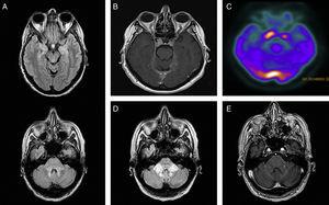 A) RM cerebral, FLAIR axial: hiperintensidad en pedúnculos cerebelosos medios (PCM), protuberancia dorsal, periacueductal mesencefálico y uncus temporales. B) RM cerebral, T1 axial con gadolinio: lesiones paraselares bilaterales que se realzan con contraste, mayor en el lado derecho, y en la tórcula y tentorio bilateral. C) PET-TC con 18F-FDG: aumento de captación en el área hipofisaria y tórcula. D) RM cerebral, FLAIR axial, a los 18 meses: progresión de la alteración de señal a nivel de los PCM. E) RM cerebral, T1 axial con gadolinio: captación nodular de contraste a nivel de PCM.
