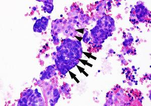 Citología de líquido pleural hemático. Imagen correspondiente a bloque celular (tinción con hematoxilina-eosina): se podían distinguir células tumorales (moldeamiento nuclear con relación núcleo/citoplasma muy elevada, abundantes figuras de mitosis y un citoplasma escaso) (flechas), entremezcladas con células mesoteliales reactivas (citoplasma más amplio y eosinófilo, más claro de color rosáceo) (puntas de flecha). En la inmunohistoquímica de las células tumorales se obtuvo un resultado positivo ante: factor 1 de transcripción tiroidea (TTF-1, indicando un origen primario pulmonar), cromogranina/sinaptofisina, CD56 y Ki-67 (MIB-1) (en el 57% de las células neoplásicas). Todo ello compatible con infiltración o metástasis de carcinoma neuroendocrino pulmonar de célula pequeña.