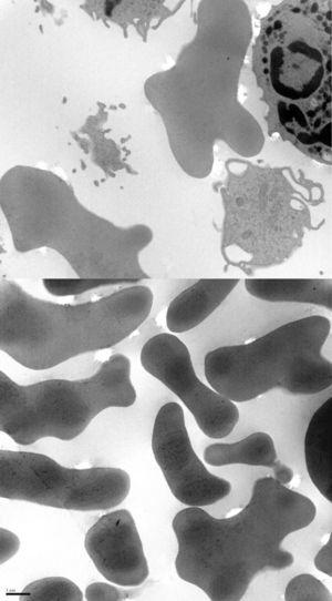Imágenes de microscopía electrónica donde se observan hematíes con proyección citoplasmática ancha.