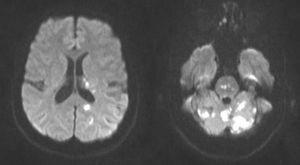RM cerebral en secuencia de difusión: se visualizan múltiples áreas que producen restricción en secuencia de difusión, la mayoría de morfología puntiforme o redondeada, situadas a nivel paraventricular izquierdo y en lóbulo temporal ipsilateral, y el resto situadas en territorio vertebrobasilar: protuberancia, lóbulo occipital izquierdo y, sobre todo, en vermis y ambos hemisferios cerebelosos.
