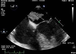 Ecocardiograma transesofágico: en aurícula izquierda se objetiva masa móvil deflecada, heterogénea, con base de implantación amplia en septo interauricular y con prolapso diastólico al ventrículo; compatible con mixoma auricular.