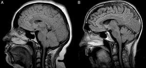 IRM vista sagital (T1-FLAIR). A) Femenino de 41 años con ELA bulbo-espinal de 6 meses de progresión. La forma, la posición y la intensidad de la lengua se observan como normales, incluyendo las estructuras internas. B) Masculino de 49 años con ELA bulbo-espinal de 23 meses de progresión. La lengua presenta forma, posición e intensidad anormales, además de pérdida de la estructura interna.