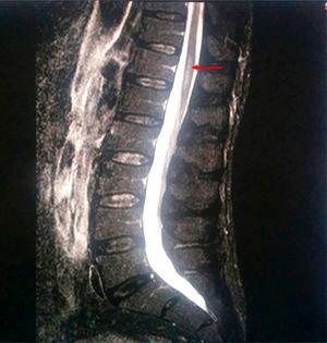Resonancia magnética de columna dorsolumbar y sacra. A nivel D9-D10 y hasta el final del cono medular se aprecia ensanchamiento del canal y cordón medular con hiperintensidad en secuencia STIR.