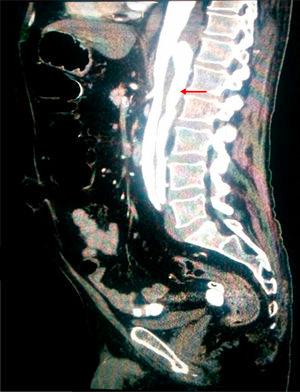 Angiotomografía computarizada de abdomen. Aorta torácica distal aneurismática. Disección aórtica que se extiende a través de aorta abdominal hasta arteria renal izquierda e ilíaca externa izquierda, con luz falsa en la parte posterior.