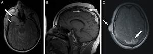 Secciones de RM del caso. A) Imagen axial craneal de RM pT2 con supresión de la señal del líquido cefalorraquídeo en la que se evidencia atrofia en el lóbulo temporal derecho (flecha pequeña) y una lesión quística hiperintensa bien delimitada situada en la fosa media que corresponde con un quiste aracnoideo (flecha grande). B) Imagen sagital craneal de RM pT1 con hallazgos muy indicativos de síndrome de Haberland. Extensa área hiperintensa localizada adyacente a la convexidad craneal superior y en línea media interhemisférica que representa la lipomatosis intracraneal (flecha grande). Calcificaciones corticales con baja intensidad de señal situada justo bajo la zona de lipomatosis (flechas pequeñas). Tumoraciones subcutáneas diversas en el cuero cabelludo (asterisco). C) Imagen axial craneal de RM pT1 a la altura de los centros semiovales donde el material lipomatoso es claramente visible en la región posterior de la línea media (flecha grande). También se aprecia un tumor benigno de partes blandas sobre el lado derecho de la escama del temporal (flecha pequeña).