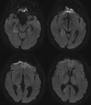 Cortes axiales de la RMN en secuencias de difusión, un mes después. Aparición de nuevas lesiones hiperintensas corticales de predomino en lóbulo occipital derecho.