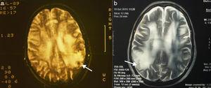 Imágenes de RM cerebral: a) (1989) T2 muestra hiper-intensidades (leucoaraiosis) paraventriculares, centro-semiovales, sin efecto de masa y más marcadas en el lado derecho, y b) (2011) T2 con imágenes similares. Las flechas indican el lugar de la biopsia.