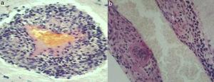 Pequeñas arterias meníngeas y encefálicas con infiltrado inflamatorio en su pared: linfocitos, histiocitos y células granulomatosas multinucleadas (H&E ×400); a) corte transversal y b) corte longitudinal.