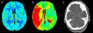 A) Sin asimetrías en mapa de volumen sanguíneo cerebral. B) Alargamiento del tiempo al pico en 6 territorios corticales de la ACM derecha. C) Oclusión M1 distal derecha en angio-TC.