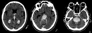 Extenso hematoma troncoencefálico centrado en la protuberancia que se extiende a mesencéfalo, diencéfalo, III y IV ventrículos, ventrículos laterales. Arteria cerebral media derecha hiperdensa.