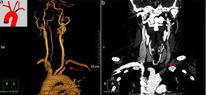 a) Angio-RNM aorta torácica con reconstrucciones; b) Angio-TAC torácico. Obstrucción total del tercio proximal de la arteria subclavia izquierda con evidencia de contraste del área postestenótica a través de la arteria vertebral izquierda.