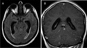 A) RM cerebral mostrando hidrocefalia comunicante en secuencia FLAIR axial. B) Realce meníngeo de contraste con tuberculomas en fosa posterior en T1 coronal tras gadolinio.