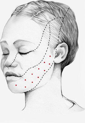 Esquema de infiltración en territorio V3 en pacientes con neuralgia del trigémino. El mapa de infiltración se puede ampliar a puntos gatillo de la cavidad oral. Se debe valorar la posibilidad de infiltrar algunos puntos de la hemifacies contralateral para reducir la probabilidad de asimetría facial.
