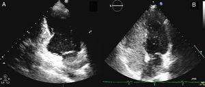 Ecocardiograma transtorácico. A. Plano de 2 cámaras que objetiva la presencia de un left ventricular outpouching (evaginación ventricular izquierda congénita) a nivel inferobasal. B. Shunt derecha-izquierda demostrado con el paso de burbujas tras la inyección intravenosa de suero salino agitado.