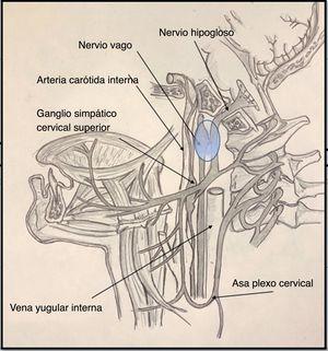 Relaciones esquemáticas del nervio hipogloso y nervio vago en el espacio retroestíleo.