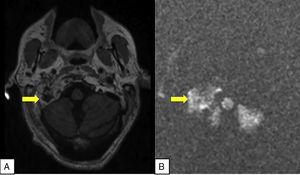 A) Imagen axial de la RM secuencia T1 con contraste intravenoso. La lesión lítica presenta una captación de contraste heterogénea afectando al cóndilo occipital y base de cráneo (flecha). B) Imagen axial de la RM secuencia difusión en la que vemos que presenta gran restricción (flecha).