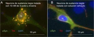Neuronas dopaminérgicas de sustancia negra en cultivo tratadas con 10μM de 3-yodo-L-tirosina (A) o solución vehículo (B), tras inmunocitoquímica para tirosina-hidroxilasa y α-sinucleína. A) Se observan numerosas inclusiones redondeadas que expresan tanto α-sinucleína (αSYN) como tirosina-hidroxilasa (TH), de ahí el color claro. Numerosos agregados se observan alrededor del núcleo. B) Se observa una neurona tratada con solución vehículo en la que hay señal clara difusa en el soma principalmente, y más oscura de TH en las neuritas. Es decir, la señal de αSYN se detecta difusa en el soma junto a TH, dando un color claro, y la señal de TH es más intensa en las neuritas. No se detectan inclusiones como en la figura A. El núcleo se tiñó con DAPI. N: núcleo. Fuente: Tomada de Frenández-Espejo26. Copyright © 2018, Fisiología, revista de la Sociedad Española de Ciencias Fisiológicas.