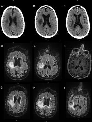 Evolución de la lesión en pruebas de imagen. TAC cerebral sin contraste que muestra hipodensidad hemisférica derecha (A), con progresión en TAC realizado una semana después (B y C). RM cerebral con lesión hiperintensa en secuencias T2-FLAIR (D y E), sin captación de contraste en T1 con gadolinio (F). Evolución posterior de las lesiones en T2-FLAIR (G-I).