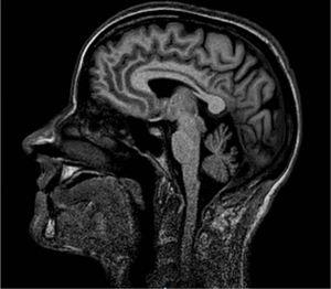 Resonancia magnética cerebral. Secuencia T1 corte sagital. Atrofia cerebelosa.
