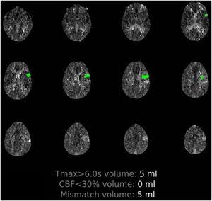 Estudio de perfusión cerebral. Se evidencia una hipoperfusión en territorios M2-M5 de la arteria cerebral media izquierda, con aumento del tiempo de tránsito medio y sin datos de área de infarto (penumbra isquémica 100%).