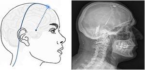 Esquema mostrando el electrodo implantado en el hipotálamo (flecha azul discontinua) a través de un orificio de trepanación frontal y cableado subcutáneo. A la derecha TC craneal post-cirugía que muestra el electrodo implantado en el hipotálamo en un paciente con cefalea en racimos crónica refractaria izquierda.