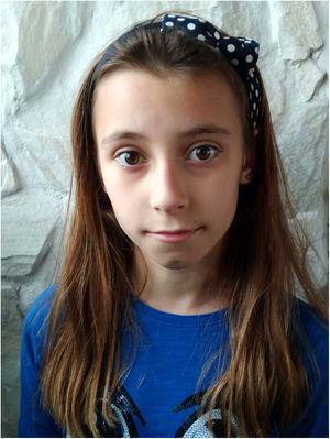 Fenotipo de la paciente a la edad de 11 años. Cara discretamente alargada, fisuras palpebrales largas, hipoplasia medio-facial, filtro profundo y punta bulbosa de la nariz.