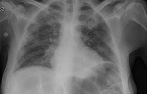 Radiografía de tórax portátil: infiltración bilateral pulmonar.