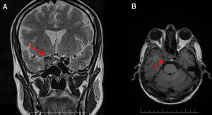 RM cerebral en secuencia T2 FLAIR corte axial (A) y T2 coronal (B) que muestra masa en seno cavernoso derecho.