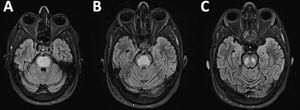 A-C) RM cerebral. Secuencia FLAIR. Extensa área hiperintensa central pontina, que alcanza el mesencéfalo caudal, con preservación del área periférica (piglet sign), compatible con mielinolisis central pontina.
