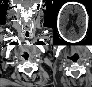 Paciente 6. A) Angio-TC axial, trombo endoluminal sobre placa de ateroma en la arteria carótida interna derecha (ACI).B) Reconstrucción coronal de angio-TC, placa de ateroma calcificada y trombo endoluminal sobre placa C) Radiografía de tórax,infiltración difusa bilateral por COVID-19. D) TC de cráneo sin contraste, con signos de infarto cerebral en el territorio de la ACMderecha.