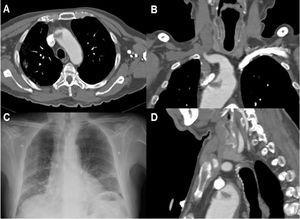 Paciente 13. A) Angio-TC axial, trombosis endoluminal sobre placa de ateroma en el arco aórtico ascendente. B) Reconstrucción coronal angio-TC. C) Radiografía de tórax, infiltrado bilateral difuso en lóbulos pulmonares inferiores y atelectasias laminares en el lóbulo inferior. D) Reconstrucción sagital de angio-TC de la trombosis endoluminal sobre placa de ateroma en el arco aórtico.