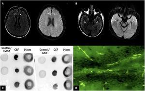 (A) MRI of the brain in T2 FLAIR and diffusion-weighted imaging showing hyperintensities in the bilateral anterior cingulate cortex and (B) bilateral temporal lobes (white arrows). (C) Dot blot (1:1000 dilution); revealing positivity for the presence of GAD65 and NMDA antigens in the CSF. (D) Tissue-based assay in CSF with direct immunofluorescence showing intracellular and cell-surface antigens (GAD65, NMDA).