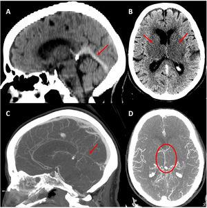 Corea Bilateral Como Forma De Presentación De Trombosis Venosa Cerebral ...