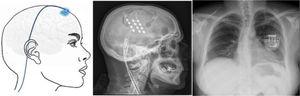 Esquema y radiografía de cráneo de perfil que muestran la ubicación de la placa de electrodos de estimulación en el córtex motor y el generador subclavicular en un dispositivo de estimulación del córtex motor en una paciente con neuralgia del trigémino refractaria a tratamientos farmacológicos, termocoagulación del ganglio de Gasser (TMCG), compresión percutánea con balón (Mullan) y descompresión microvascular (DCMV) (Hospital de la Santa Creu i Sant Pau).