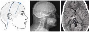 Esquema, radiografía de cráneo en perfil y tomografía axial computarizada craneal que muestran el trayecto, a través de trepanación, del electrodo de estimulación hasta su inserción en el tálamo en una paciente con neuralgia del trigémino refractaria secundaria a esclerosis múltiple (Hospital de la Santa Creu i Sant Pau).