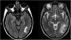 a) IRM con lesión hiperintensa en T2, localizada en región temporo-occipital izquierda, en el momento del diagnóstico de LMP. b) IRM realizada dos meses después, al diagnosticar SIRI, en la que se objetiva un aumento del tamaño de la lesión y edema perilesional.