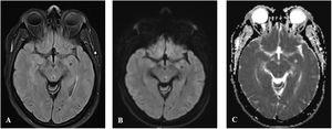 Corte axial de resonancia magnética cerebral que muestra lesión mesencefálica paramediana: hiperintensa en FLAIR (A) y B100 (B), con correspondiente hipointensidad en ADC (C).