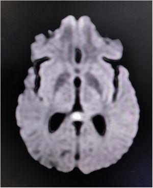 Axial diffusion-weighted MRI showing low-diffusion signal arising from the splenium of the corpus callosum, suggestive of a cytotoxic lesion.