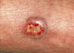 Úlcera de bordes indurados y fondo sucio en la pierna de un paciente en tratamiento crónico con corticoides por penfigoide ampolloso. En el cultivo se identificó Alternaria alternata.