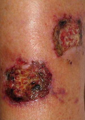 Úlceras producidas por Fusarium solanii. En la periferia se observan lesiones purpúricas de morfología lineal, resultado de la tendencia a invadir los vasos sanguíneos.