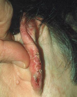 Placa eritematosa infiltrada, mal delimitada, con escamocostras y erosiones, que simulan lupus vulgar debido a infección crónica por Fusarium oxysporum.