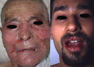 Extensas zonas erosivas afectando la cara (izquierda) y la semimucosa labial (derecha) de 2 pacientes con necrolisis epidérmica tóxica. Se observan áreas de despegamiento epidérmico.