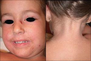 Síndrome de la piel escaldada estafilocócica: descamación fina periorificial y en la cara posterior del cuello.