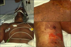 Síndrome del shock tóxico estreptocócico: lesiones cutáneas maculosas eritemato violáceas, de límites mal definidos y generalizadas.