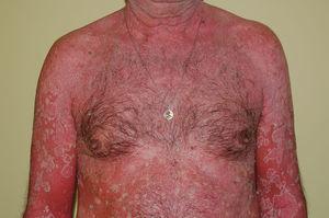 Eritrodermia en un paciente con pitiriasis rubra pilaris.